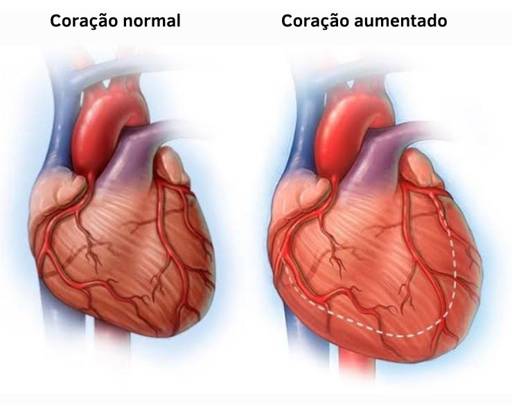 Insuficiência cardíaca, coração - Foto: Reprodução